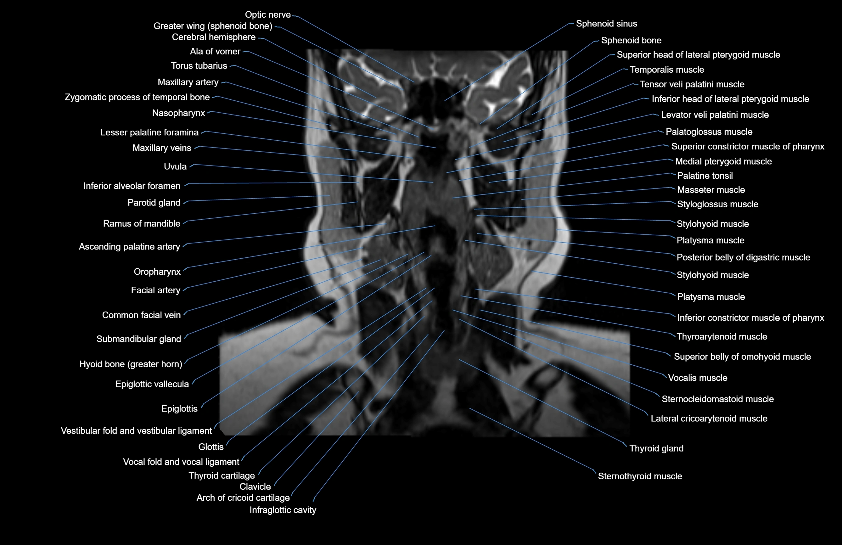 Neck coronal cross sectional MRI anatomy 3T MRI  image-img-00001-00045.webp